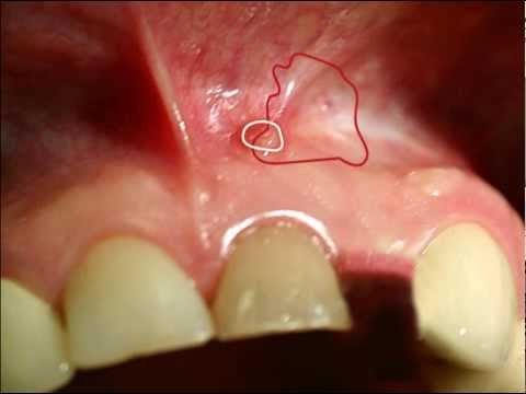 Video: Domácí Léky Na Absces Zub: 10 Léků Na Otoky A Bolesti