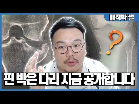 분쇄 골절 된 제 다리, 수술 전/후 사진 비교 들어갑니다.