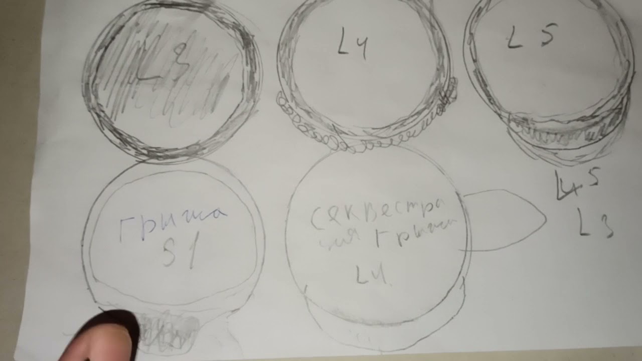 Как защемляет седалищный нерв и можно ли колоть уколы диклофенак натрия ...