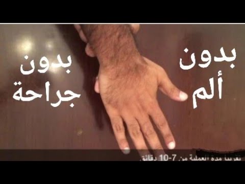 فيديو: 4 طرق لإزالة الشظايا عند الأطفال