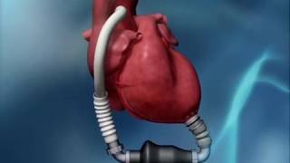 HeartMate II LVAD Animation