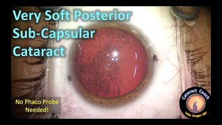 I/A probe only (no phaco probe) for Cataract Surgery with a very soft PSC Cataract screenshot 2