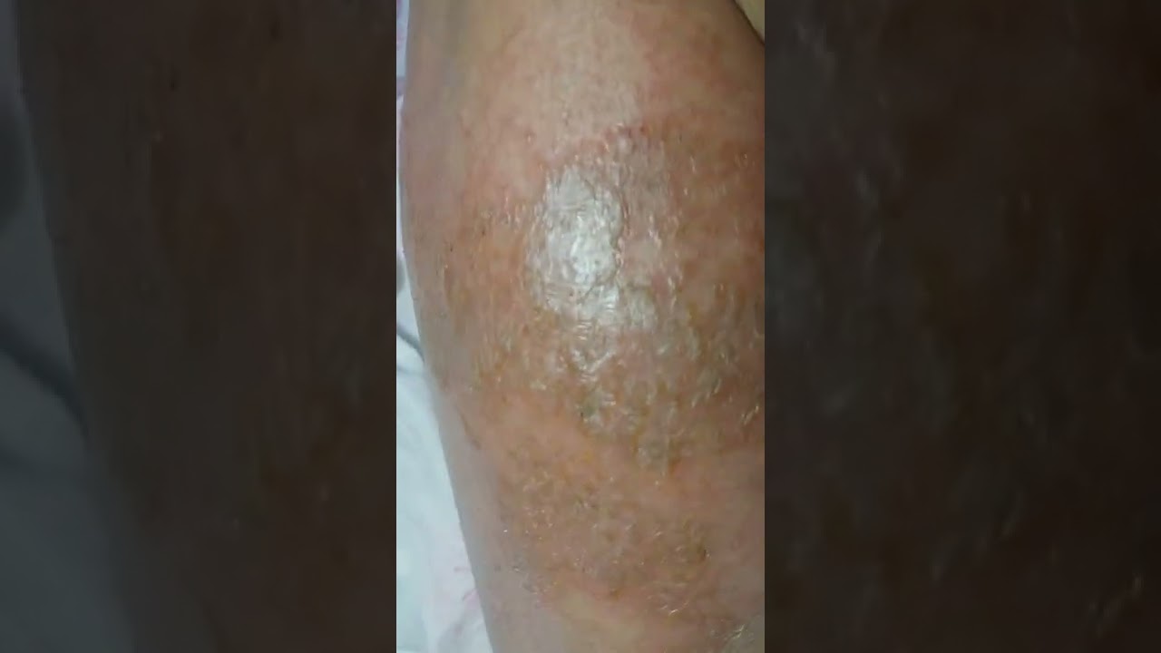 Itching, oozing legs by Mind Control Weapon YouTube