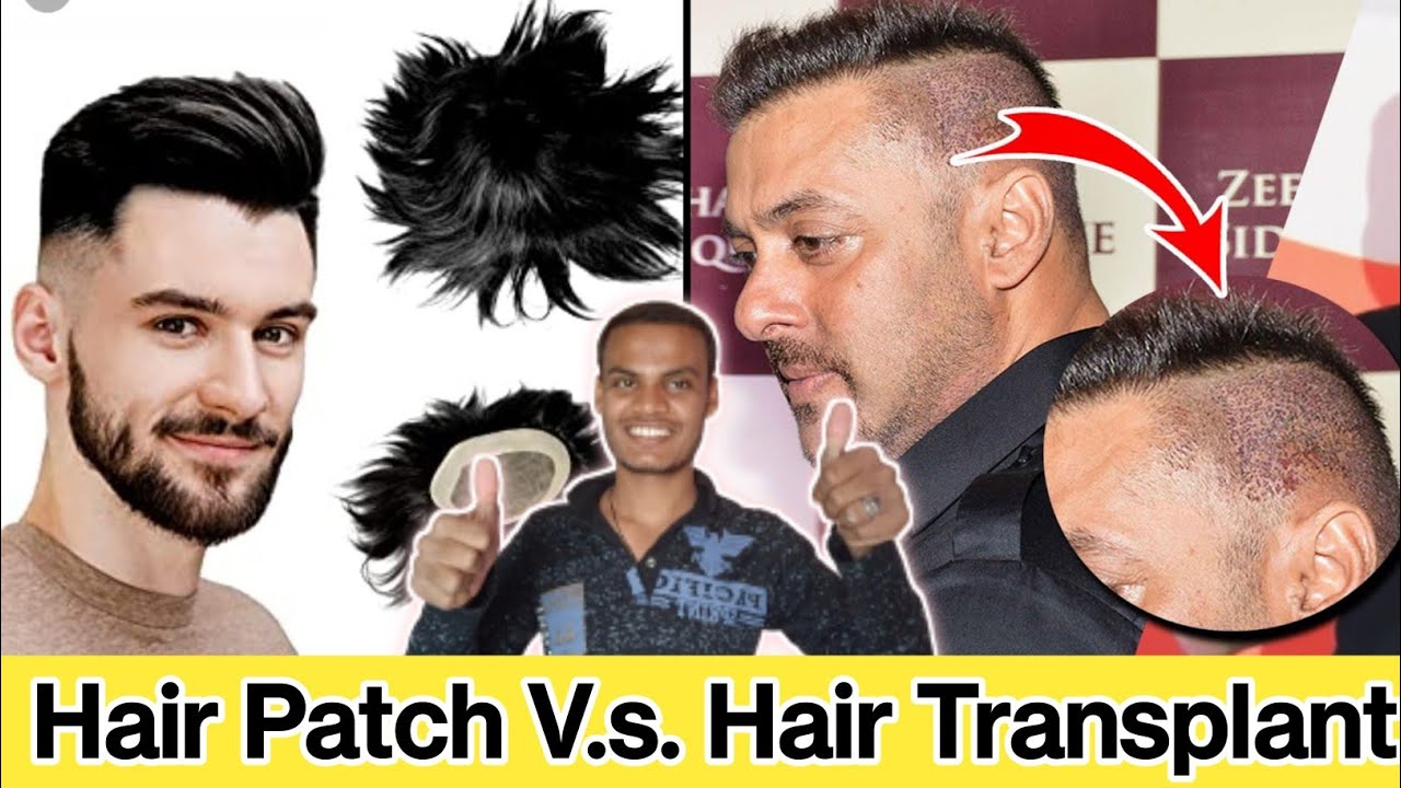 Hair Transplant Side Effects Vs Hair Patch Side Effects In Hindi Hair hair-transplant-side-effects-vs-hair-patch-side-effects-in-hindi-hair