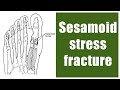 Sesamoid stress fracture surgery in runners