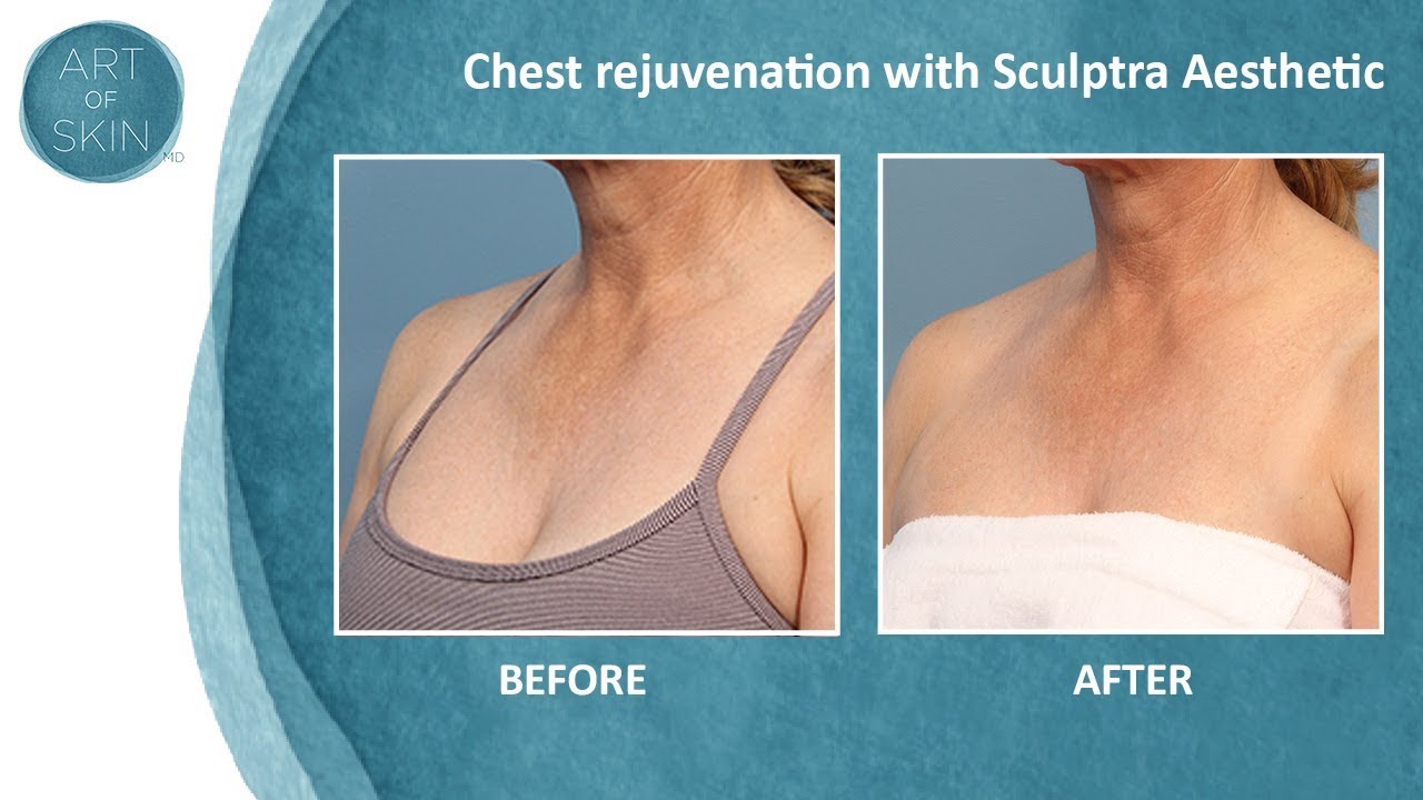Sculptra chest rejuvenation of décolletage YouTube