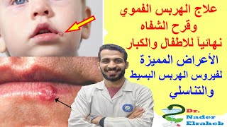 علاج الهربس الفموي وقرح الشفاه نهائيآ للاطفال والكبار_الأعراض المميزة لفيروس الهربس البسيط والتناسلي