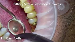 Fitting Screw Retained Crowns screenshot 3