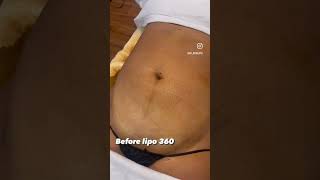 Atlanta Liposuction Specialty Clinic : Lipo 360 before and after #lipo #liposuction #lipo360