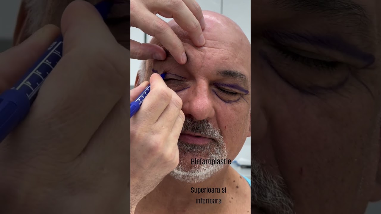 Desen preoperator înainte de operația de Blefaroplastie superioară și inferioară [Doctor Levy]
