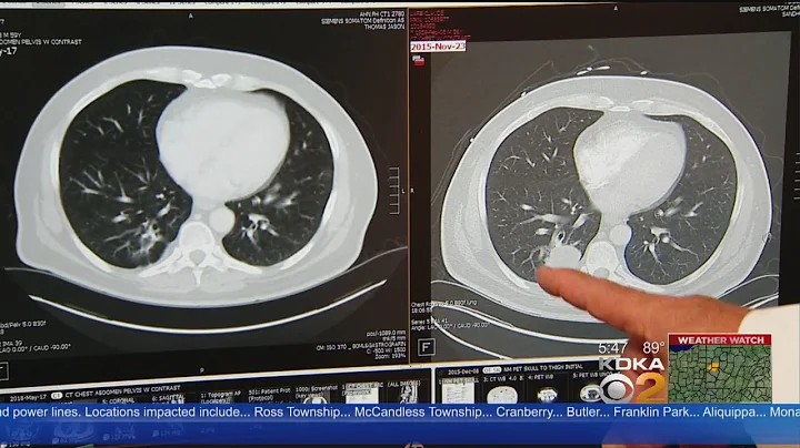 Immunotherapy Being Studied As Possible Lung Cancer Treatment