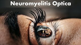 Neuromyelitis optica: clinical features, diagnosis and management by Internal Medicine 2,524 views 4 years ago 6 minutes, 49 seconds