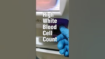 leukocytosis or high WBC count #hematologylab #laboratory #medtechstudent #cls #mls #rmt #bloodcells