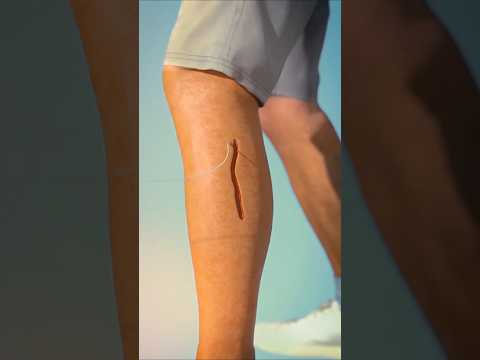 ازاي الغرز بتلم الجرح