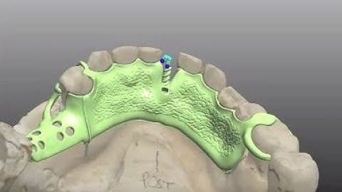 3Shape CAD training for lingual plate RPD--#2