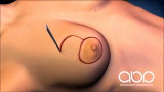 Breast correction surgery