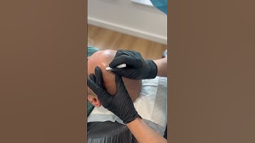 The Ultimate Hair Loss Treatment! #scalpmicropigmentation #smp #shorts