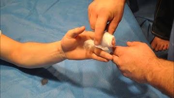 Radial gutter splint movie