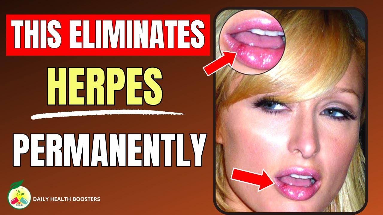 IT KILLS the Herpes Virus DEFINITELY Herpes Simplex Simptoms and