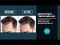 Temple Hair Loss - Does PRP Treatment Really Work For Hair Regrowth?