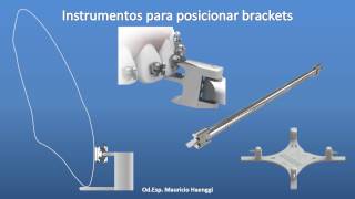 Ubicación de los Brackets