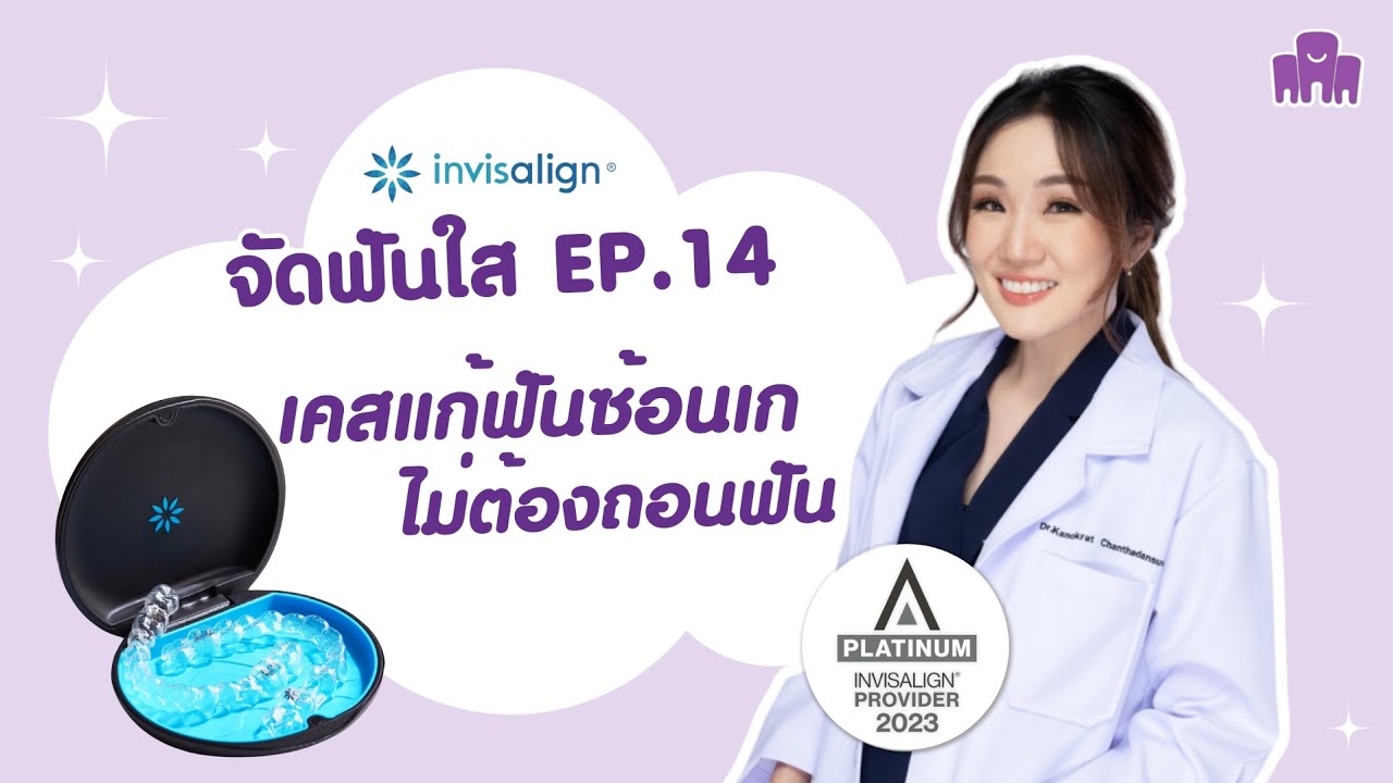 รีวิวจัดฟันใส invisalign EP.14 | แก้ฟันซ้อนเก ไม่ต้องถอนฟัน  | ครอบครัวฟันดี ระยอง