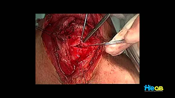 Quais os riscos da cirurgia de Traqueoplastia?