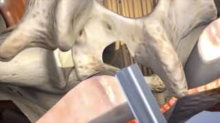 Laminotomy Animation - 360 Ortho and Spine