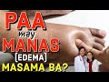 PAA May Manas (EDEMA) MASAMA BA? - Payo ni Doc Willie Ong #173c