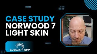 Case Study Norwood 7 SMP Light Skin Grey Beard
