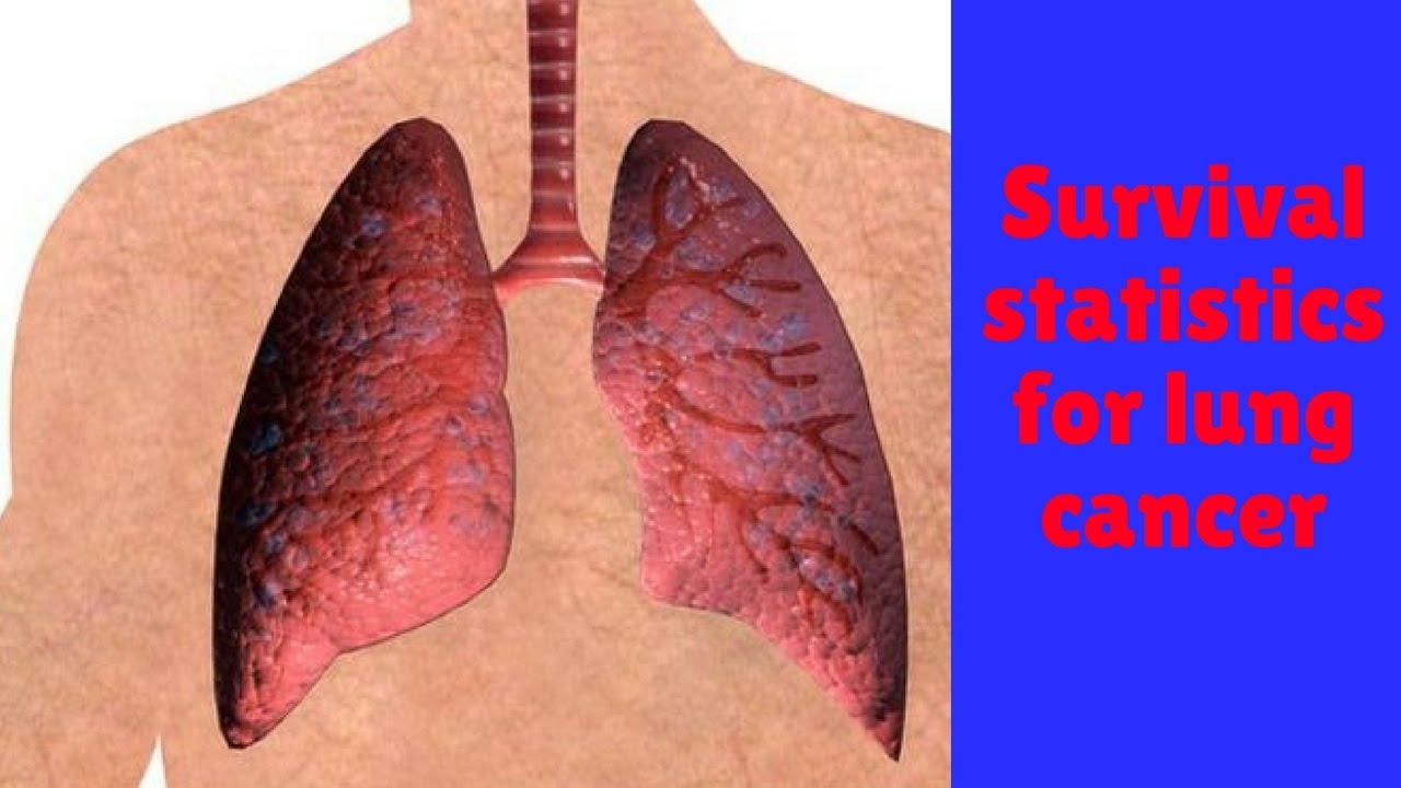 Survival statistics for lung cancer - YouTube