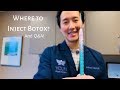 Where to Inject Botox? And Q&A!