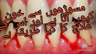 bleeding gums مسوڑھوں سے خون کیوں آتا ہے اور اس کے علاج کا