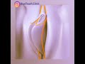 فیلم نحوه عمل لابیاپلاستی 