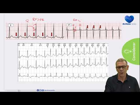 Vídeo: A taquicardia sinusal inapropriada pode desaparecer?