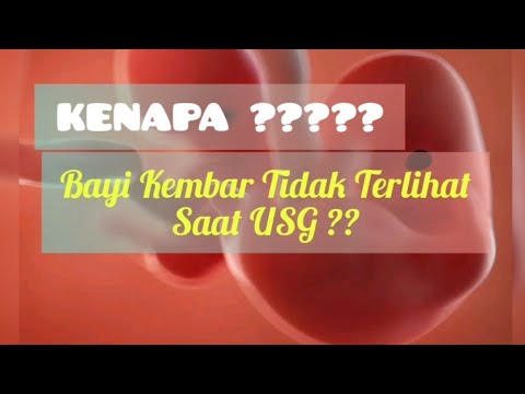 Video: Bisakah anak kembar terlewatkan saat USG?