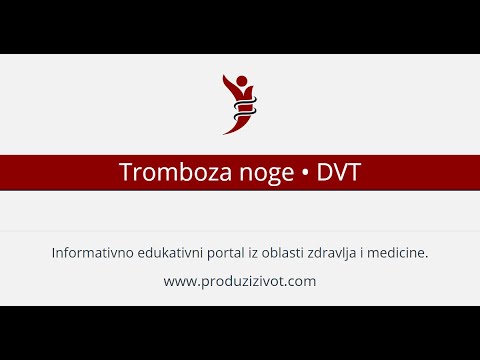 Tromboza noge • DVT duboka venska tromboza