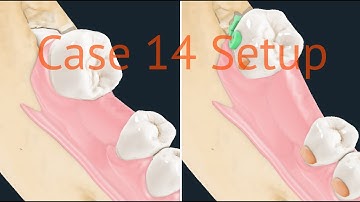 Maestro 3D aligners virtual setup: case 14, molars