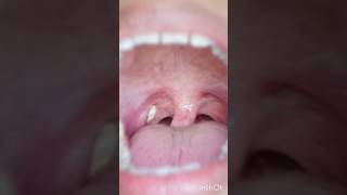 tonsil ka ilaaj Ayurveda hindi video shorts ayurveda tonsil