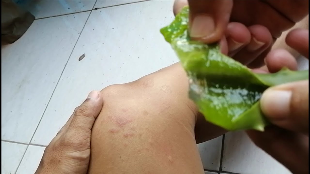 CARA MENGOBATI GATAL DOMPO KULIT CEPAT MURAH