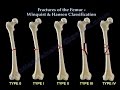Fractures Of The Femur Shaft Winquist & Hansen  - Everything You Need To Know - Dr. Nabil Ebraheim