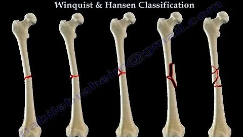 Fractures Of The Femur Shaft Winquist & Hansen  - ...