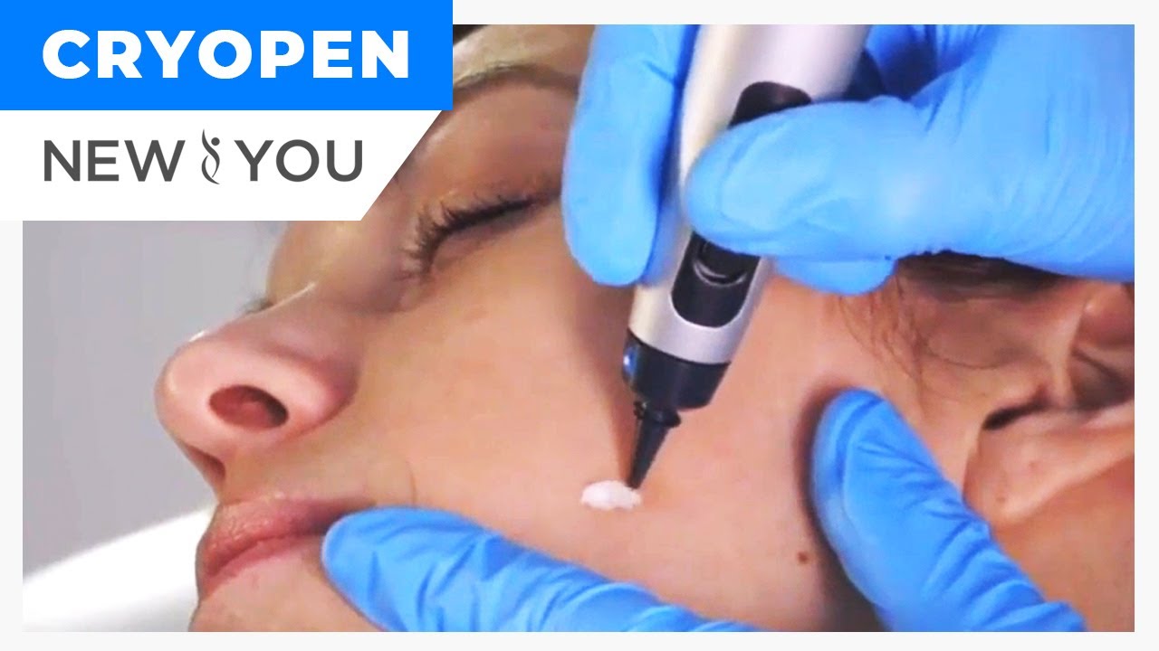 CRYO PEN | Treatments | New You Med Spas