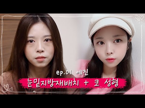 코성형 6주차 후기 영상 썸네일