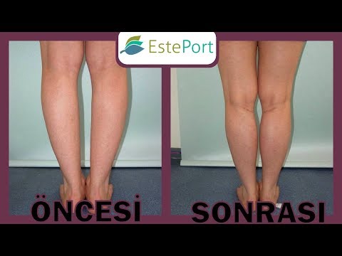 Çarpık Bacak Estetiği Öncesi ve Sonrası [2018]