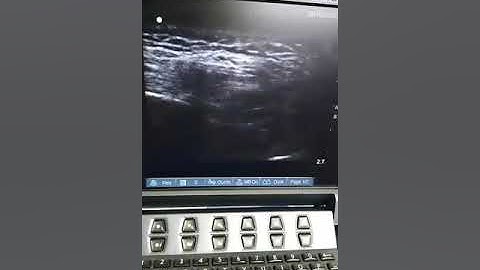 Trigeminal nerve block through US guided sphenopalatine injection