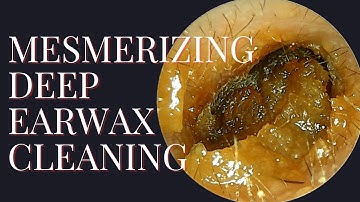 MESMERIZING Deep Earwax Cleaning (Very Satisfying Video)