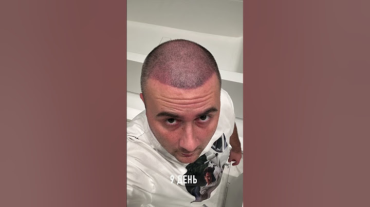 ДО и ПОСЛЕ, Пересадка волос! Алистаров Андрей