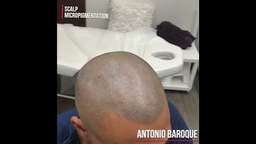 GRATE TRANSFORMATION of Scalp Micropigmentation by Antonio Baroque