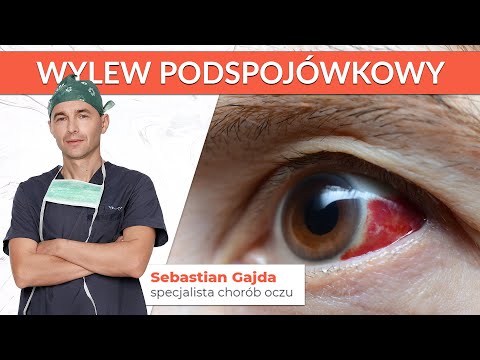 Czym jest wylew podspojówkowy?